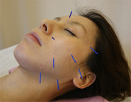 鍼・灸(はり・きゅう)